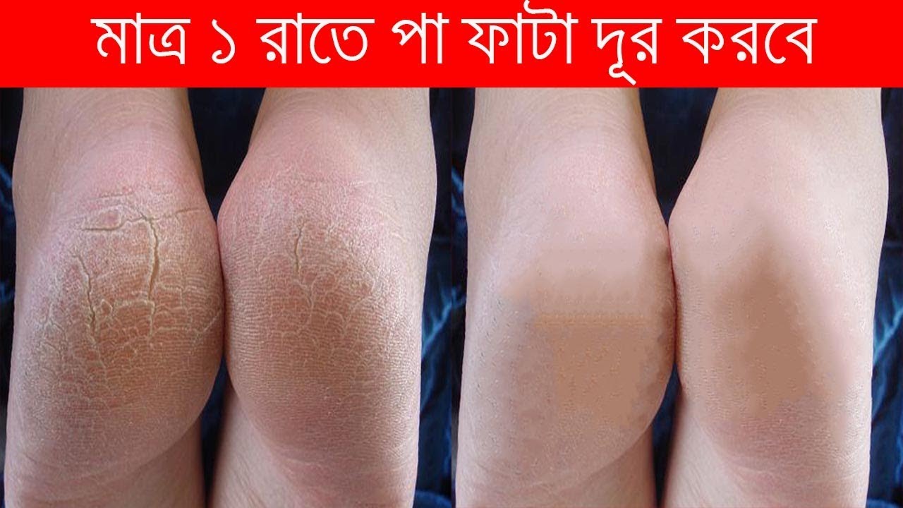 পায়ের গোড়ালি ফাটা রোধে কিছু সহজ উপায়